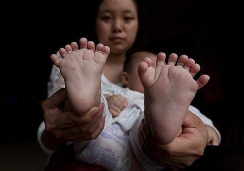Polydaktylie bei einem chinesischen Kind